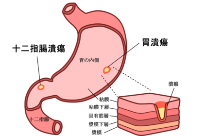 胃潰瘍・十二指腸潰瘍とは