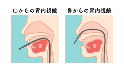 経口・経鼻内視鏡の選択が可能